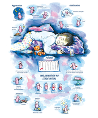 Tableaux médicaux Ferrum phosphoricum. Inflammation au stade initial.