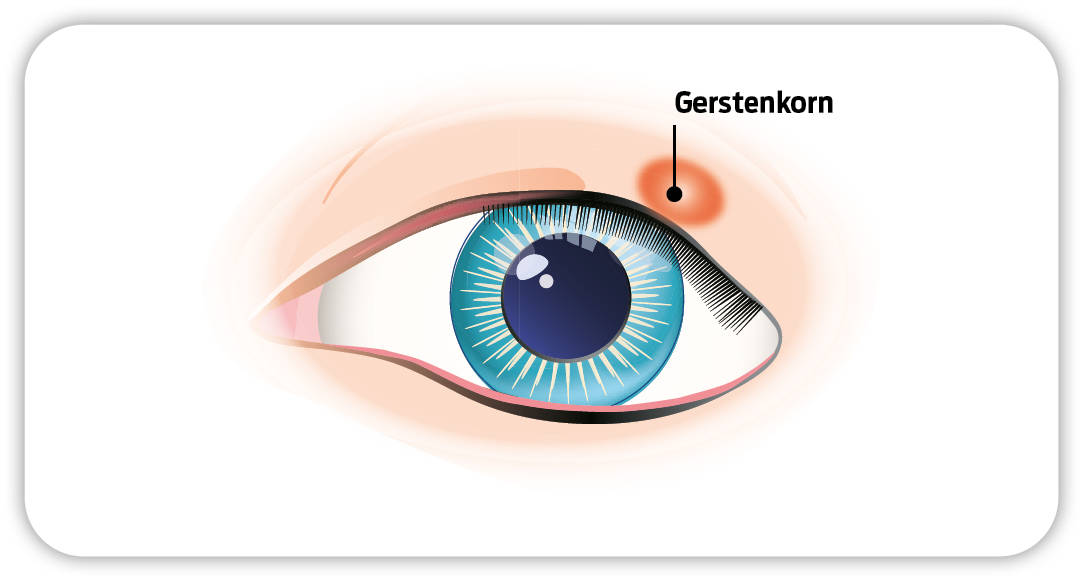 Augenillustration mit eingezeichnetem Gerstenkorn über dem Auge.