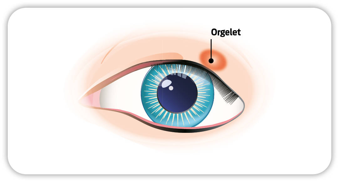 Illustration de l'œil avec un orgelet dessiné au-dessus de l'œil.