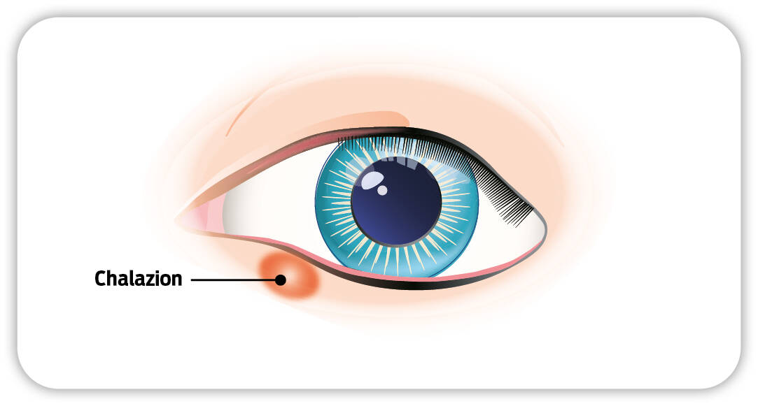 Augenillustration mit eingezeichnetem Chalazion unter dem Auge.