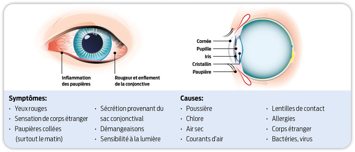 Inflammation des  paupières. Rougeur et enflement de la conjonctive.