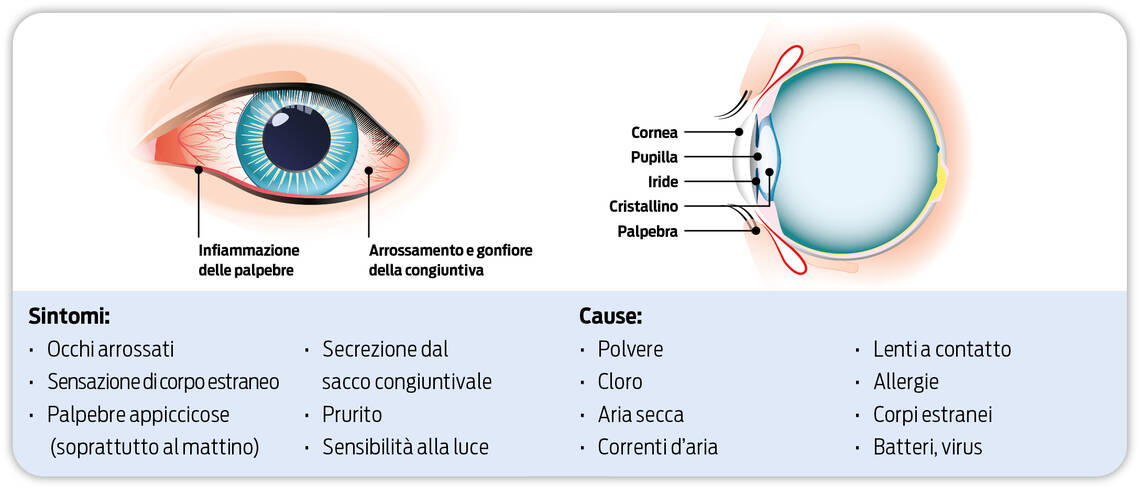 Inflammazione delle palpebre. Arrossamento e gonfiore della congiun