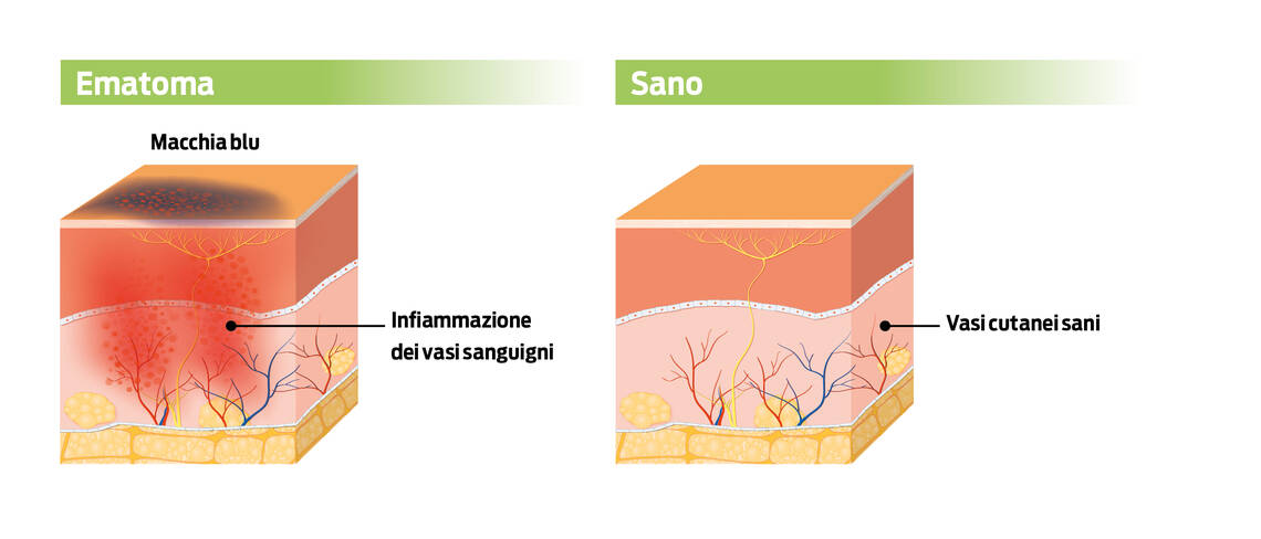 Inflammazione dei vasi sanguigni