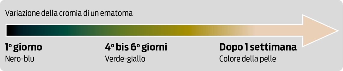 Variazione della cromia di un ematoma
