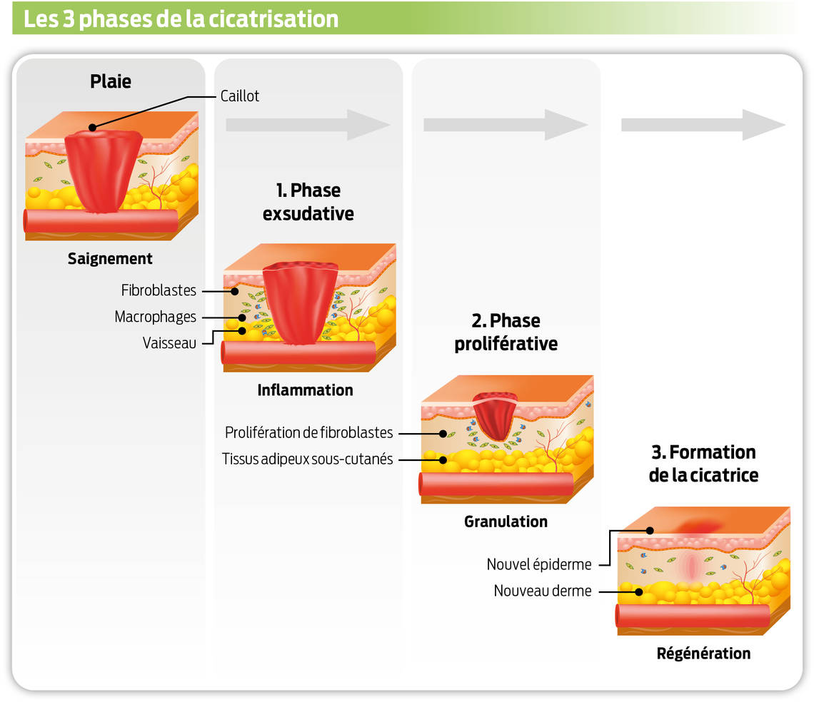 Graphique illustrant les 3 phases de la cicatrisation. 1. phase exsudative, 2. phase proliférative, 3. formation de la cicatrice